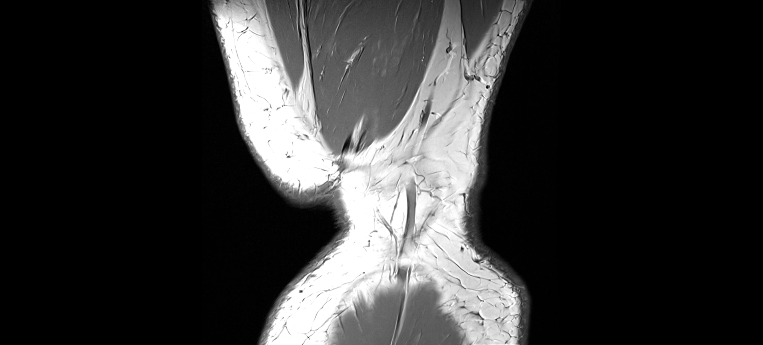MRI coronal  ligaments cross sectional anatomy 3T  radiology  image-img-04001-00044.webp